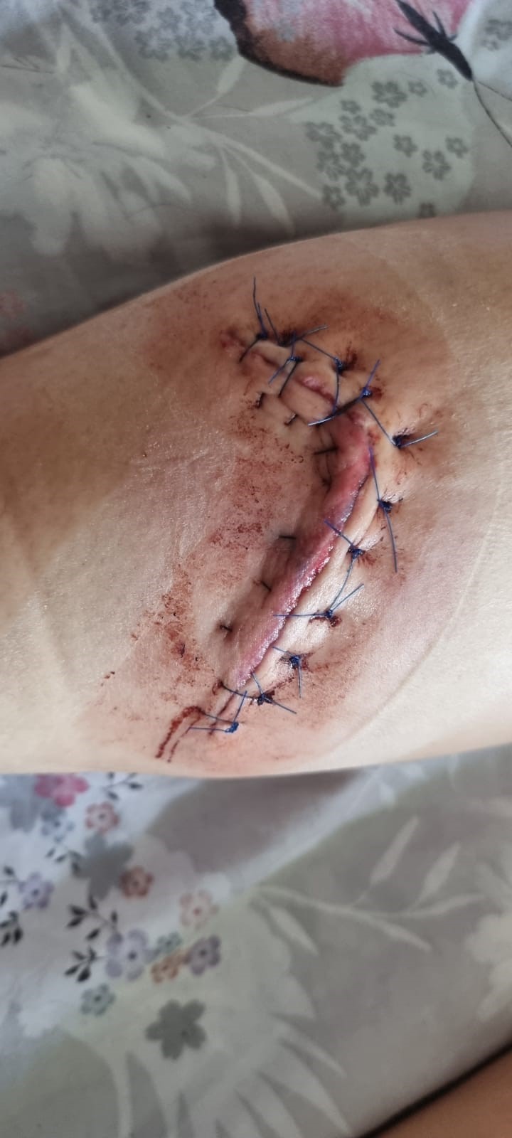 Finley had to have 15 stitches in her leg Picture: Finley Taylor