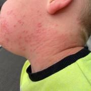 Caterpillar rash: Mum's warning to parents after brown tail moth leaves son with rash. (PA)