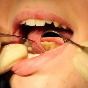 Emergency dental care is available across Gwent according to health bosses.
