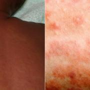 Measles outbreak declared in Gwent by Public Health Wales
