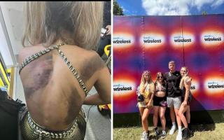 Tegan Badham's burns after the fall onto the Tube tracks (L) and right: with her friends at Wireless Festival 2022 on the Friday before the incident. Pictures: Tegan Badham